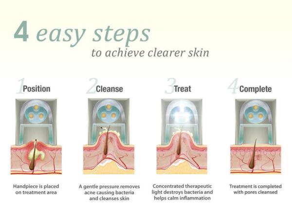 theraclear singapore, acne treatment singapore